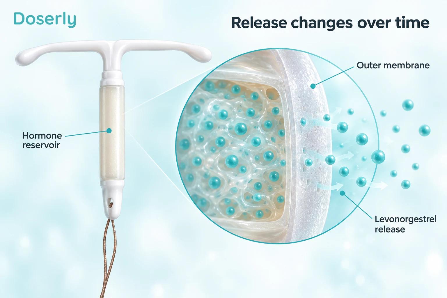 Hormonal IUD with an enlarged reservoir and membrane illustrating levonorgestrel release.