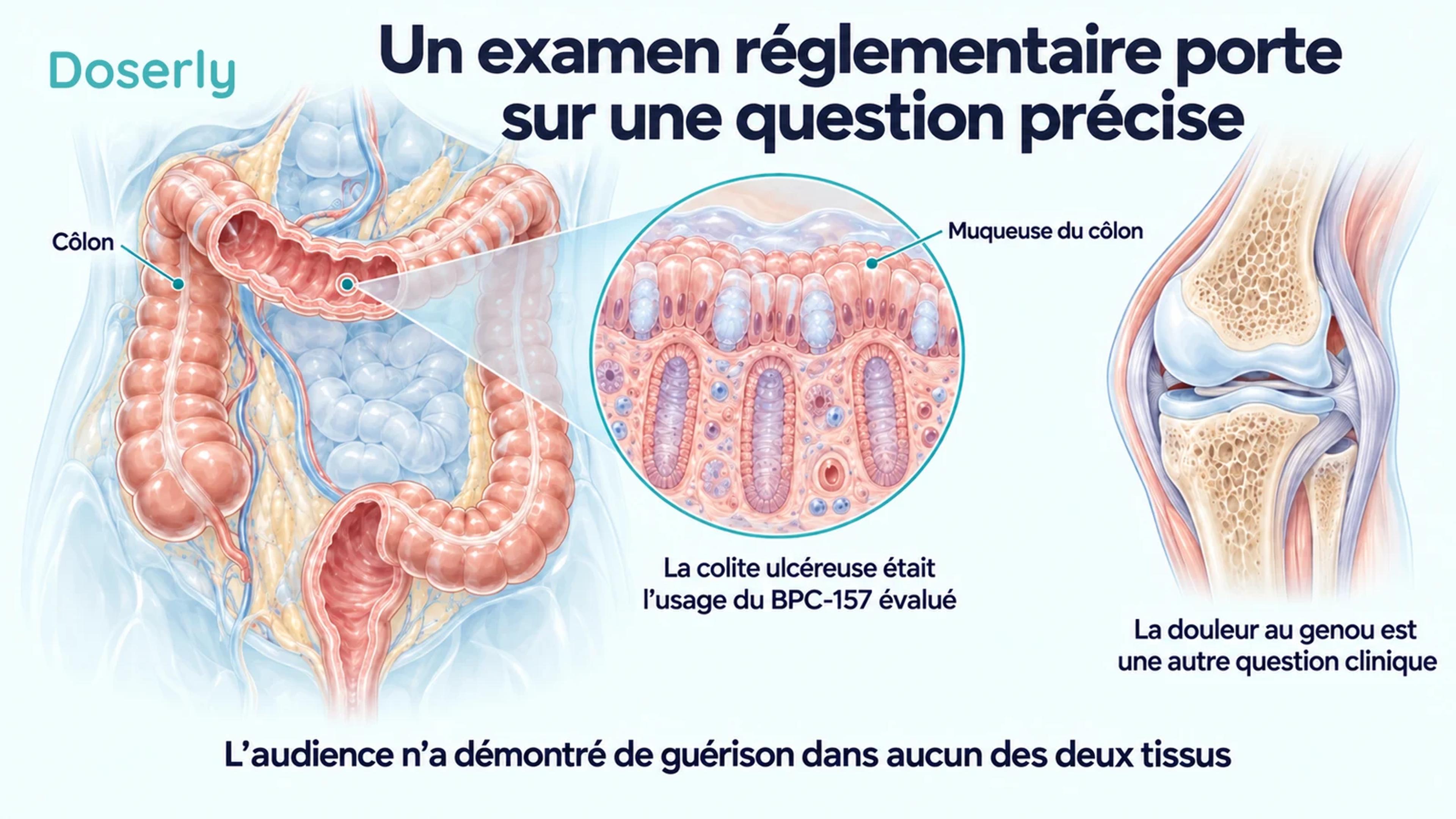 Une vue anatomique détaillée du côlon et de sa muqueuse, à côté d’une coupe du genou, montre que la colite ulcéreuse et la douleur au genou sont des questions cliniques distinctes.