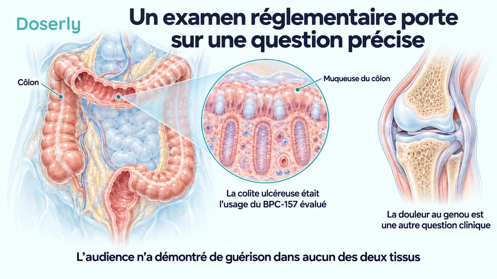 Une vue anatomique détaillée du côlon et de sa muqueuse, à côté d’une coupe du genou, montre que la colite ulcéreuse et la douleur au genou sont des questions cliniques distinctes.