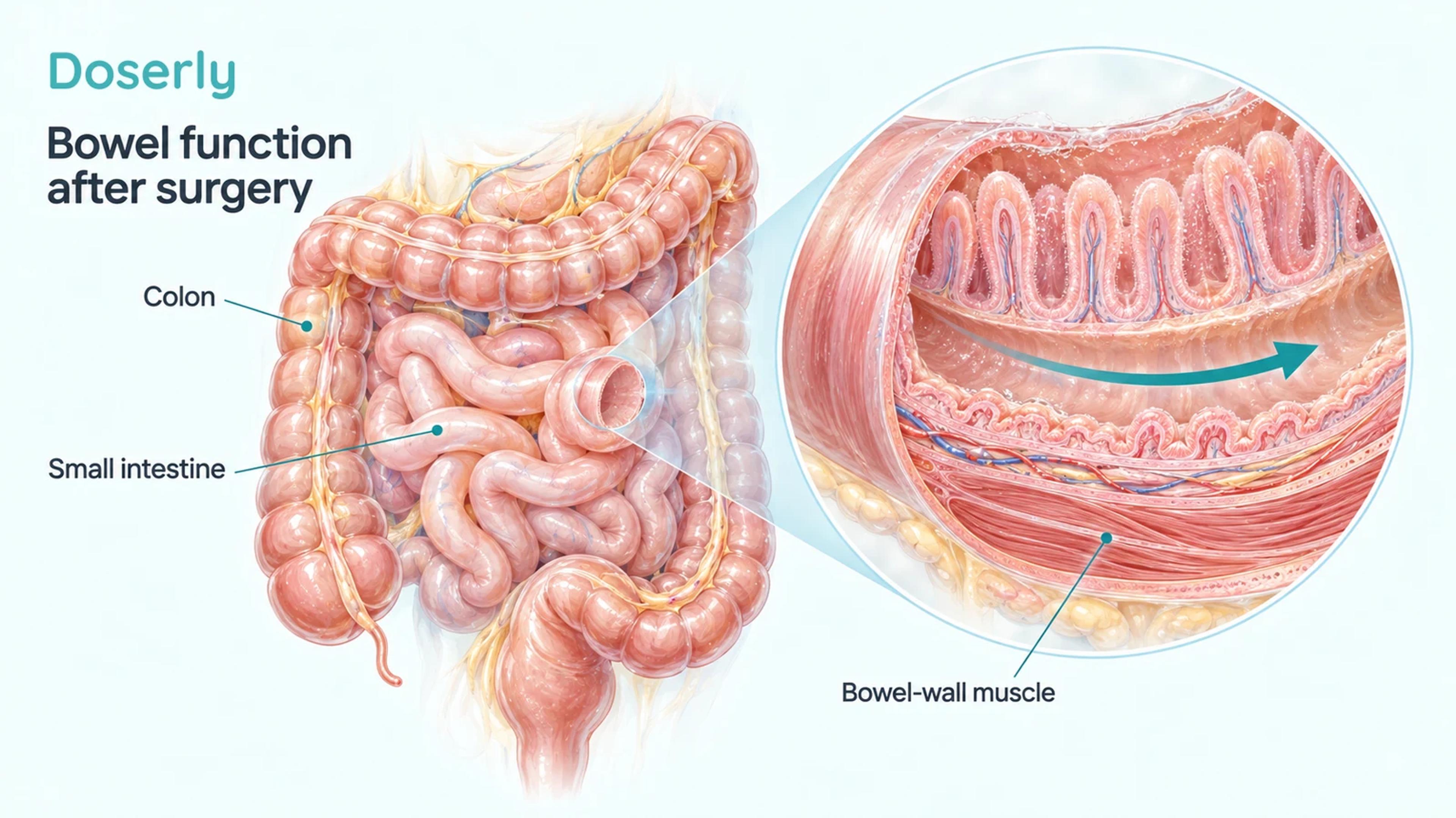 Detailed intestinal anatomy and an enlarged bowel-wall cutaway illustrate coordinated movement through the gut after surgery.