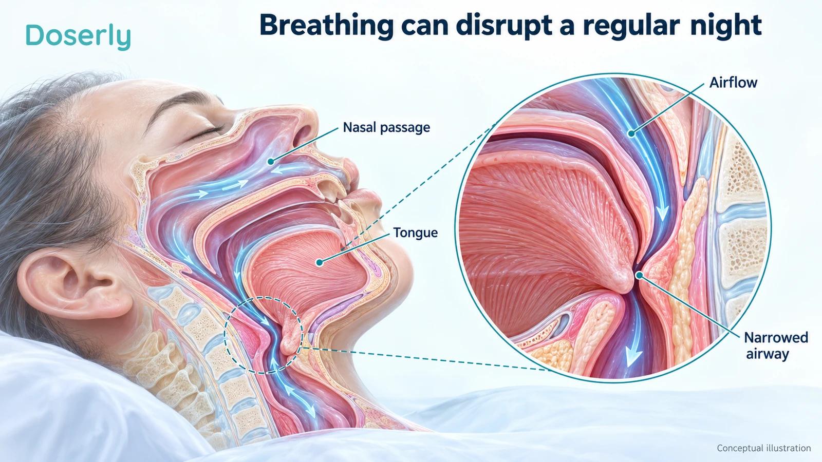 Conceptual upper-airway anatomy during sleep with an enlarged area of narrowing behind the tongue.