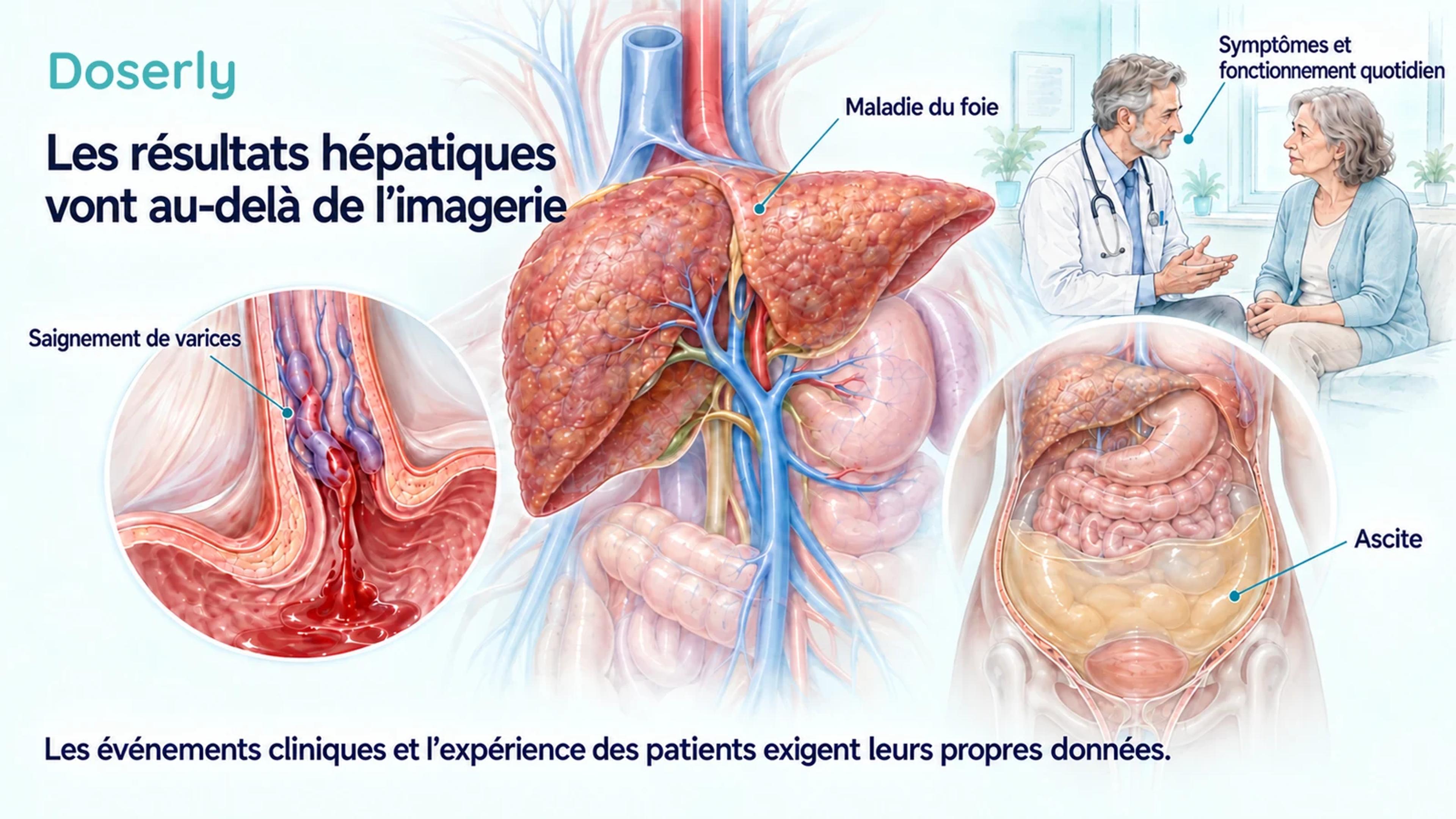 Anatomie du foie avec des illustrations d’un saignement de varices œsophagiennes, d’une accumulation de liquide abdominal et d’un clinicien discutant de symptômes avec un patient.