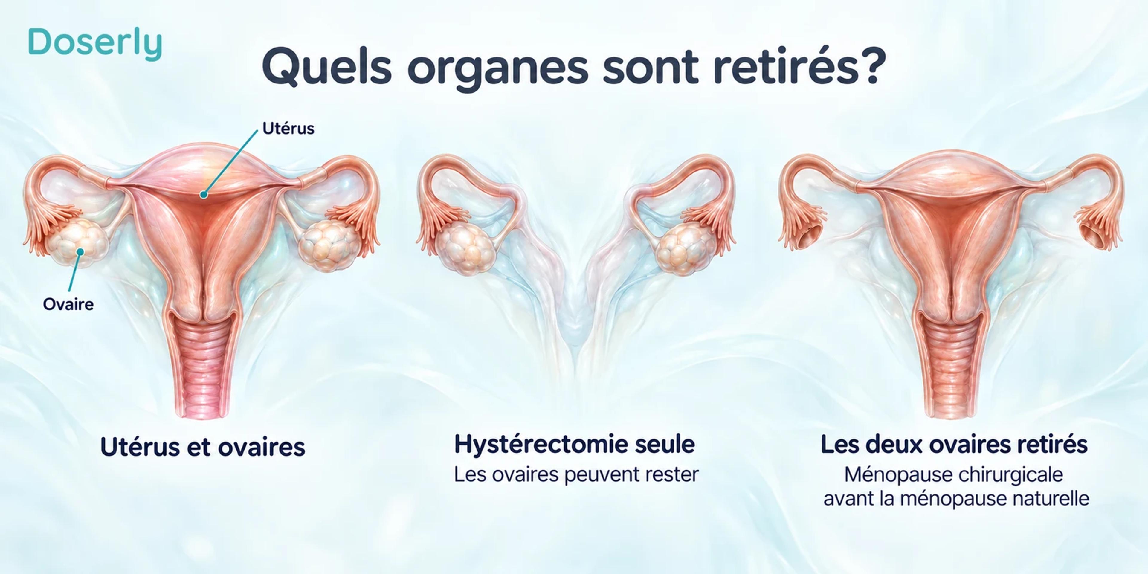 Comparaison anatomique distinguant l’utérus et les ovaires, l’hystérectomie avec conservation des ovaires et le retrait des deux ovaires.
