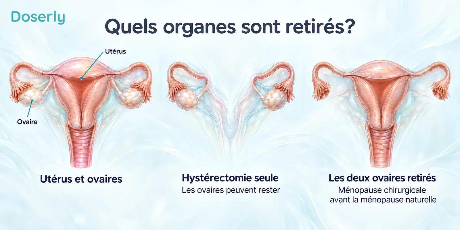 Comparaison anatomique distinguant l’utérus et les ovaires, l’hystérectomie avec conservation des ovaires et le retrait des deux ovaires.