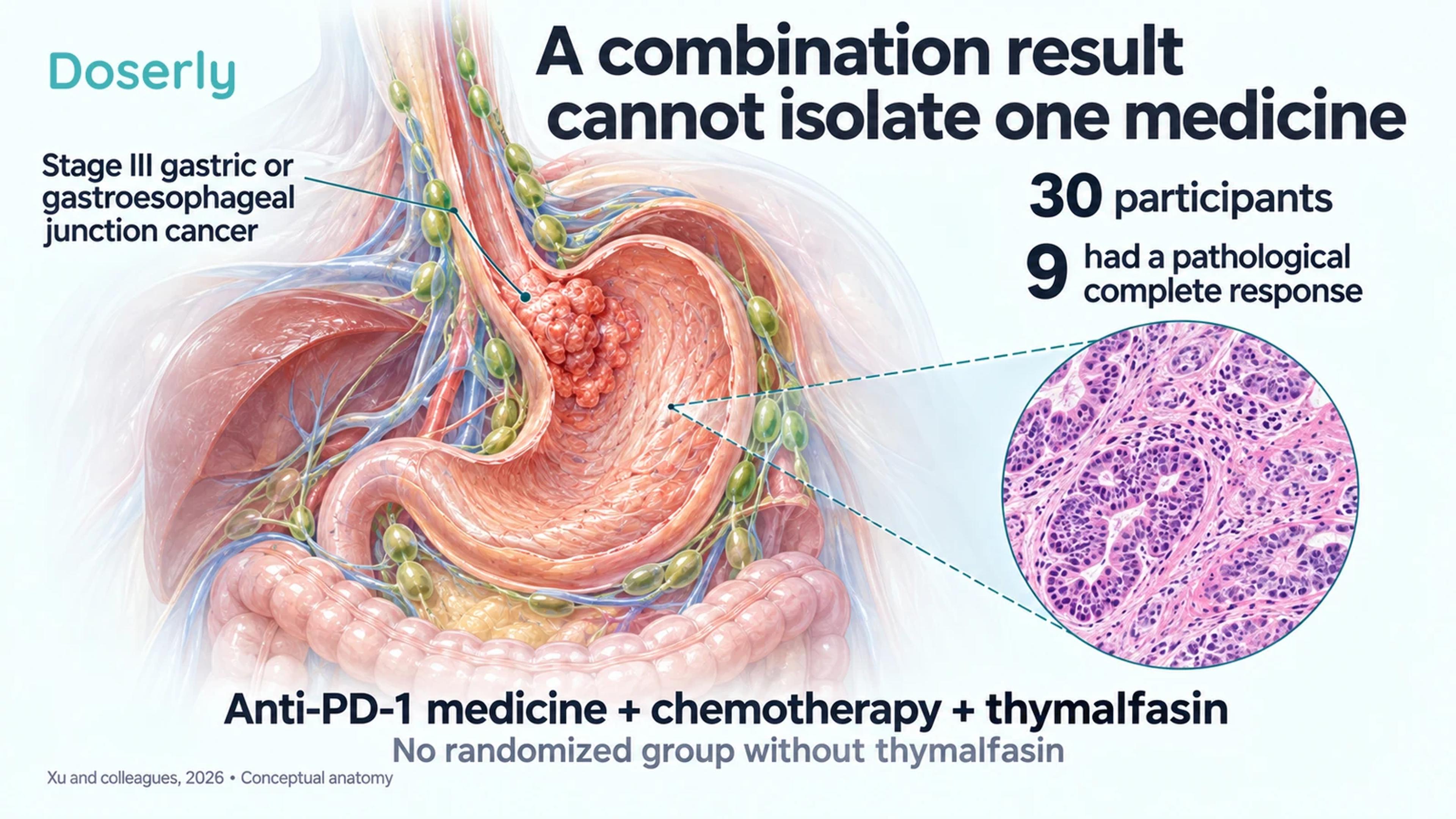 Stomach and nearby lymph-node anatomy with a conceptual pathology inset illustrate the 30-person combination study.