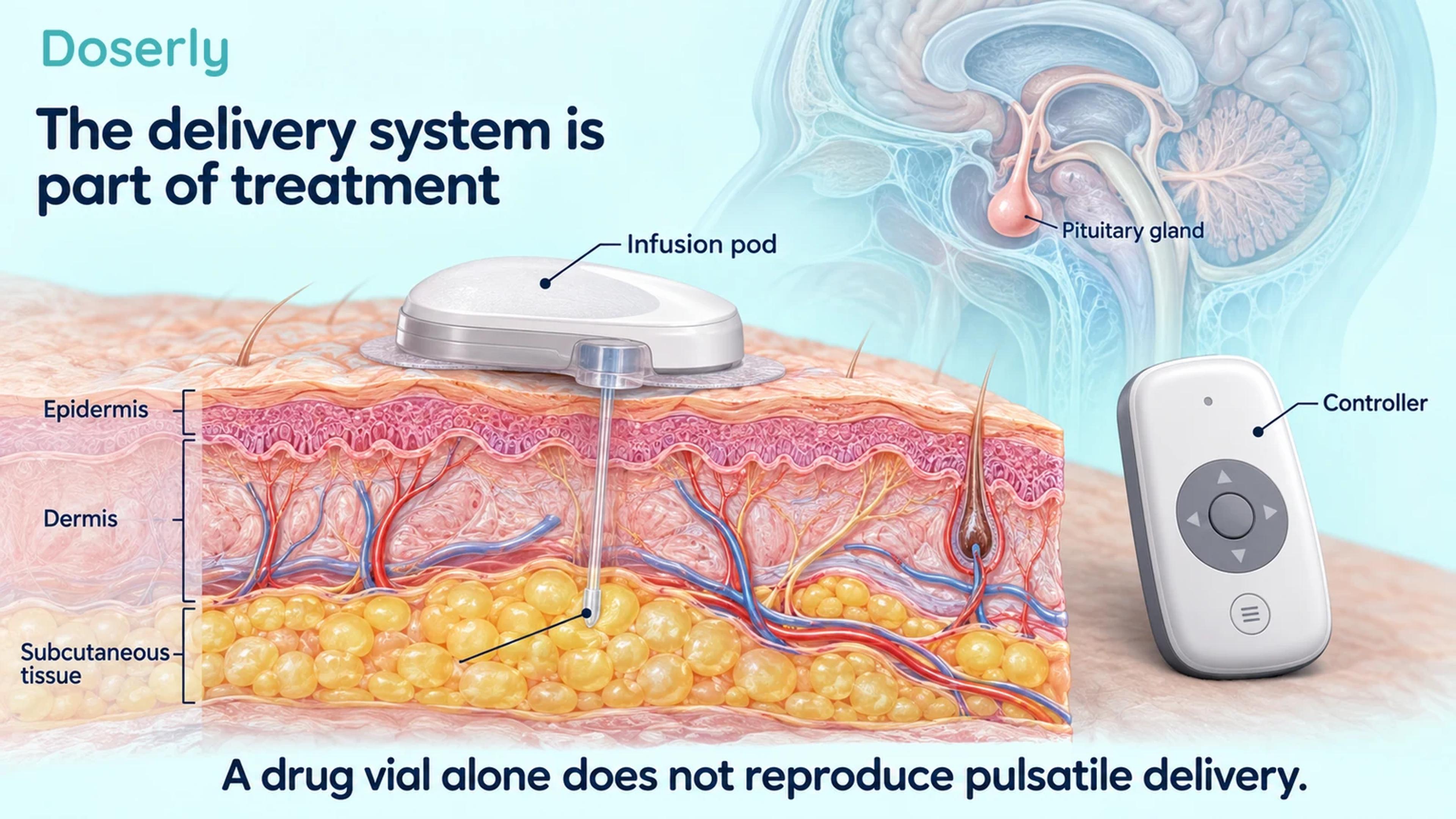 Detailed generic infusion pod above a skin cross-section, a separate controller and a pituitary anatomy inset illustrating the components of pulsatile treatment.