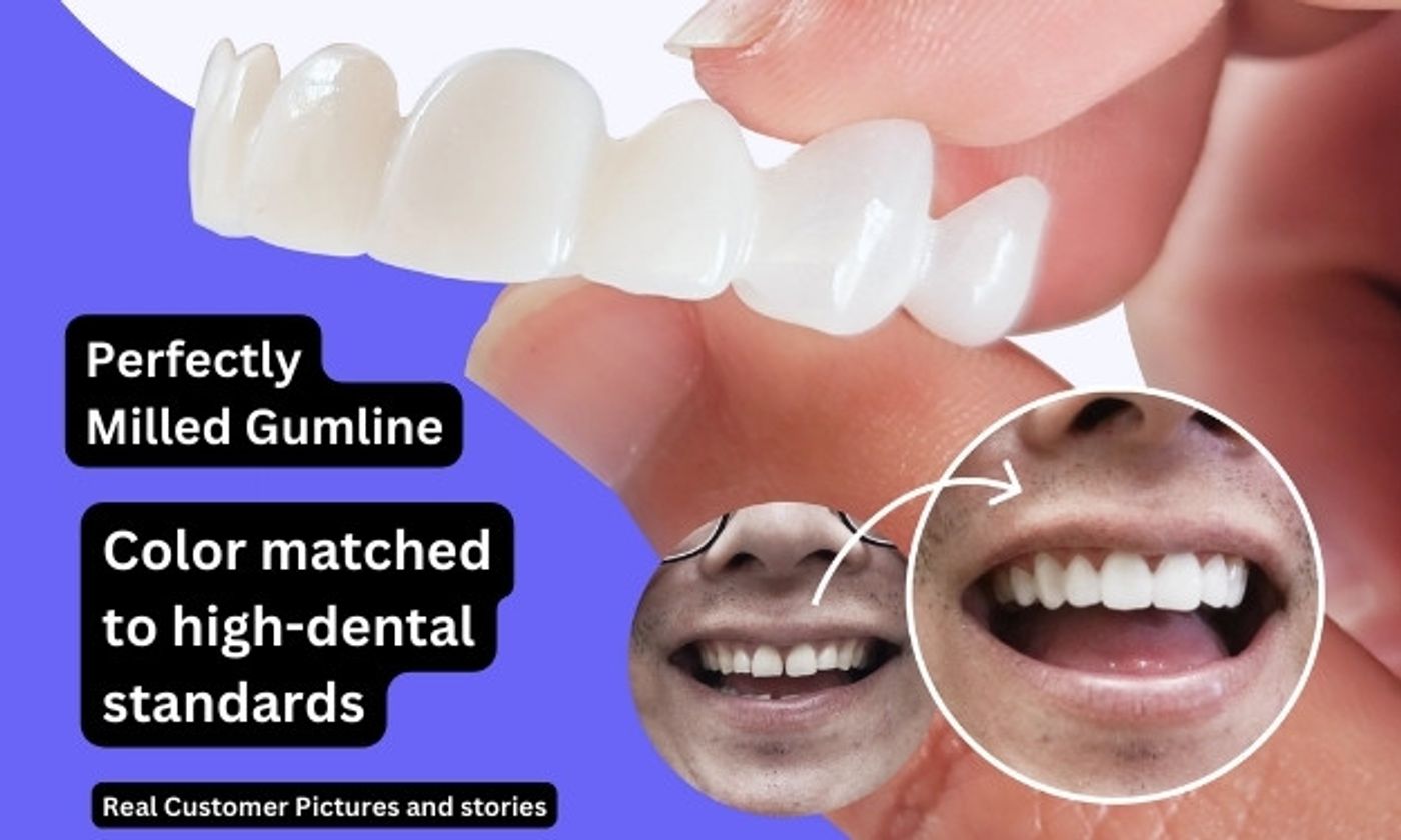 dintle veneers