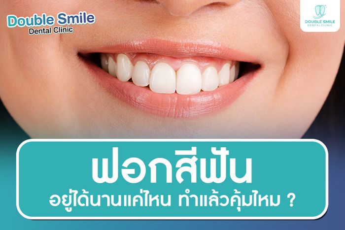 ฟอกสีฟันอยู่ได้นานแค่ไหน ? ทำแล้วคุ้มไหม