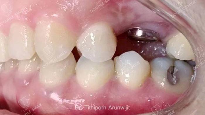 เคสรีวิวรากเทียม 18