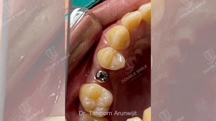 เคสรีวิวรากเทียม 17