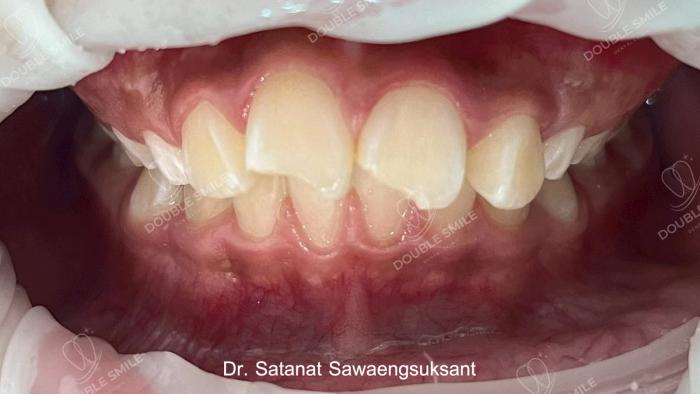 เคสรีวิวอุดฟันและวีเนียร์ 40