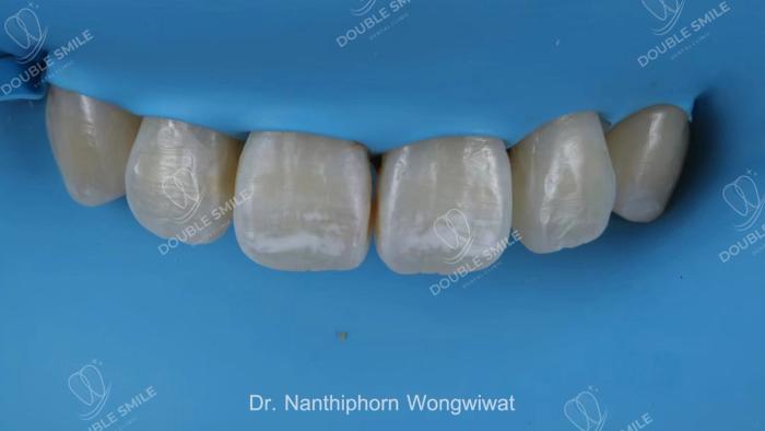 เคสรีวิวฟอกสีฟัน 9