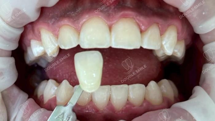 เคสรีวิวฟอกสีฟัน 15