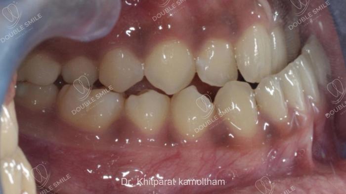 เคสรีวิวที่ 51