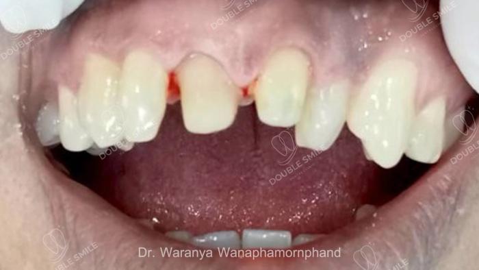เคสรีวิวฟันปลอม ครอบฟัน 13