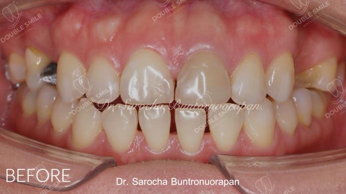เคสรีวิวอุดฟันและวีเนียร์ 36