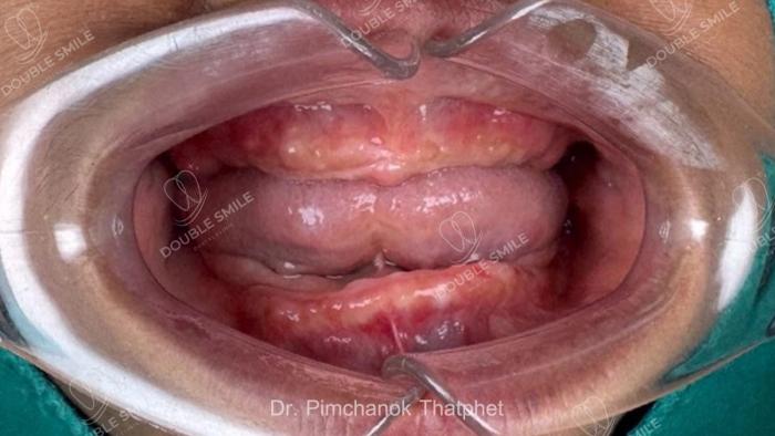 เคสรีวิวฟันปลอม ครอบฟัน 14