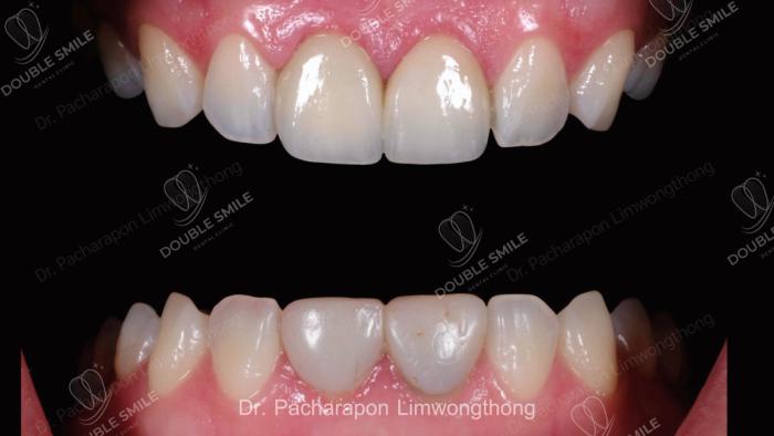 เคสรีวิวอุดฟันและวีเนียร์ 48