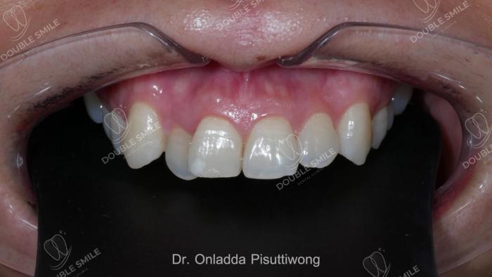 เคสรีวิวอุดฟันและวีเนียร์ 10