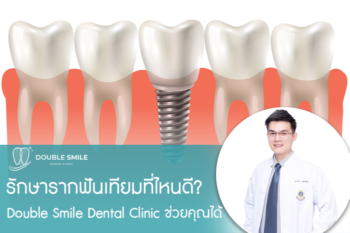 รากฟันเทียมที่ไหนดี Double Smile ช่วยคุณได้