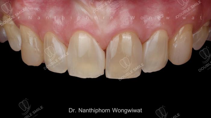 เคสรีวิวอุดฟันและวีเนียร์ 33