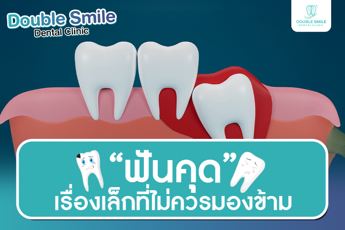 ฟันคุด เรื่องเล็กที่ไม่ควรมองข้าม