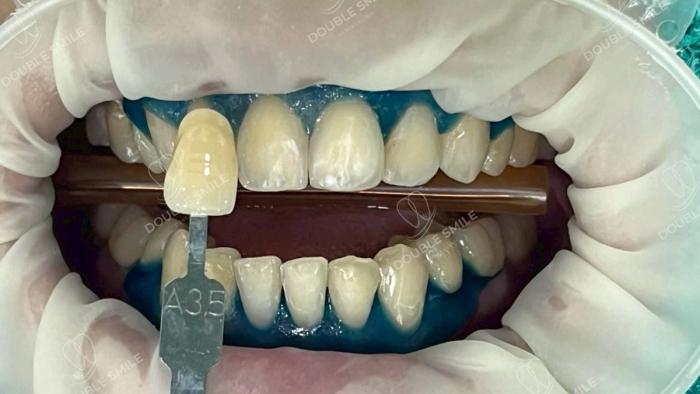 เคสรีวิวฟอกสีฟัน 14