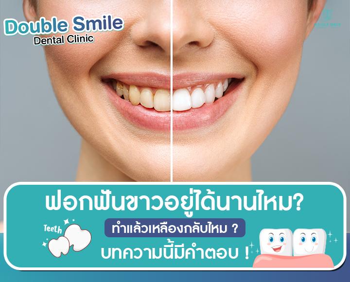 ฟอกฟันขาวอยู่ได้นานไหม? ทำแล้วเหลืองกลับไหม? บทความนี้มีคำตอบ!