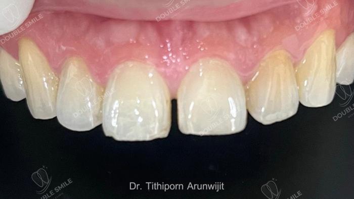 เคสรีวิวอุดฟันและวีเนียร์ 42