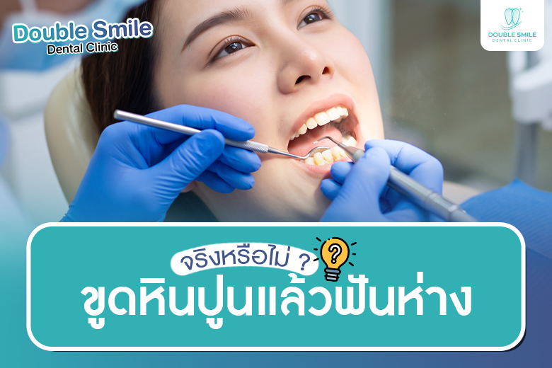 จริงหรือไม่? ขูดหินปูนแล้วฟันห่าง