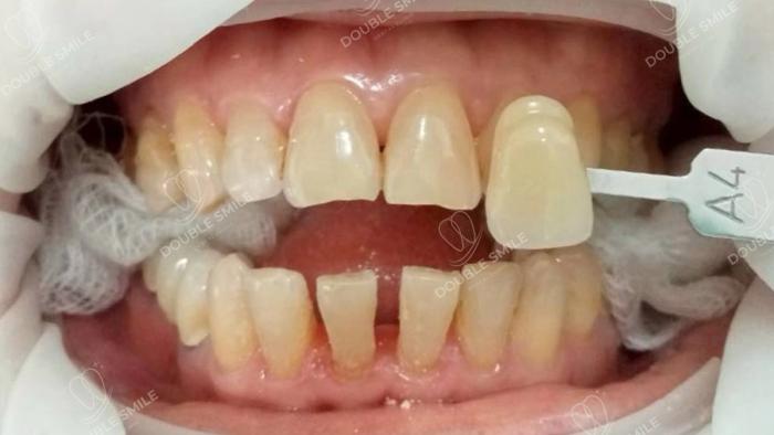 เคสรีวิวฟันปลอม 11