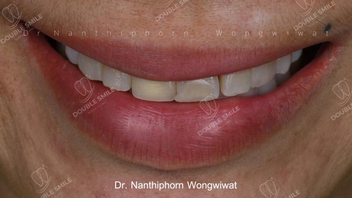 เคสรีวิวอุดฟันและวีเนียร์ 38