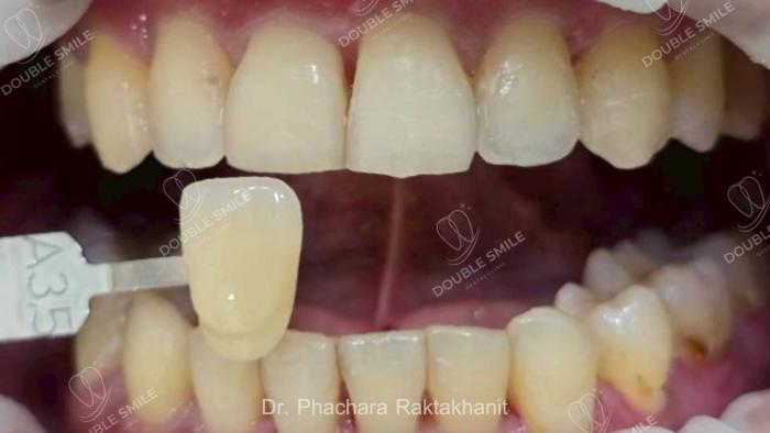 เคสรีวิวฟอกสีฟัน 13