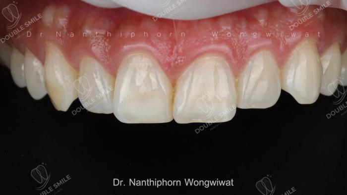 เคสรีวิวอุดฟันและวีเนียร์ 34