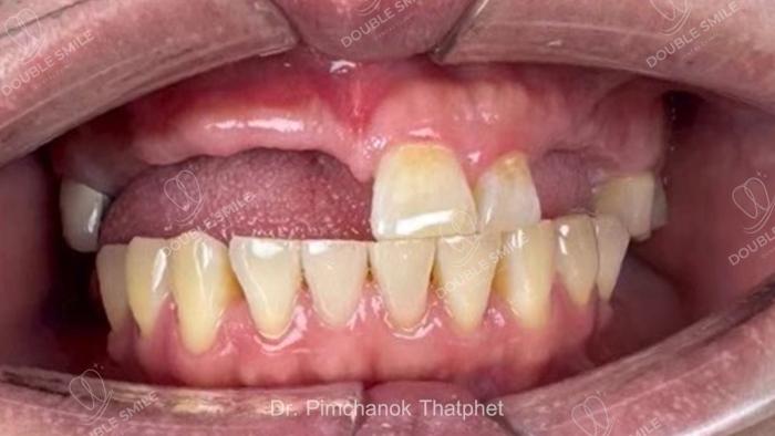 เคสรีวิวฟันปลอม ครอบฟัน 15
