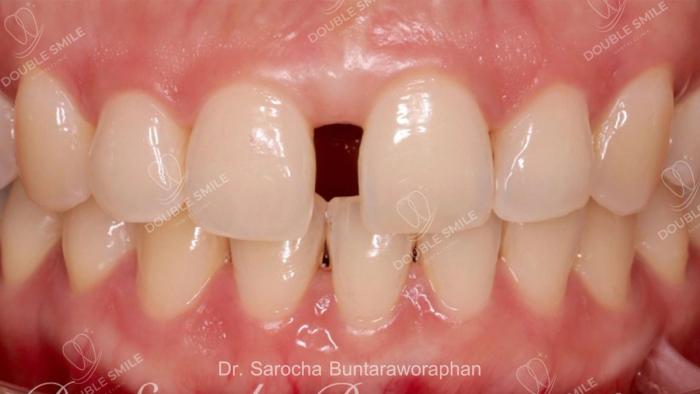 เคสรีวิวอุดฟันและวีเนียร์ 43