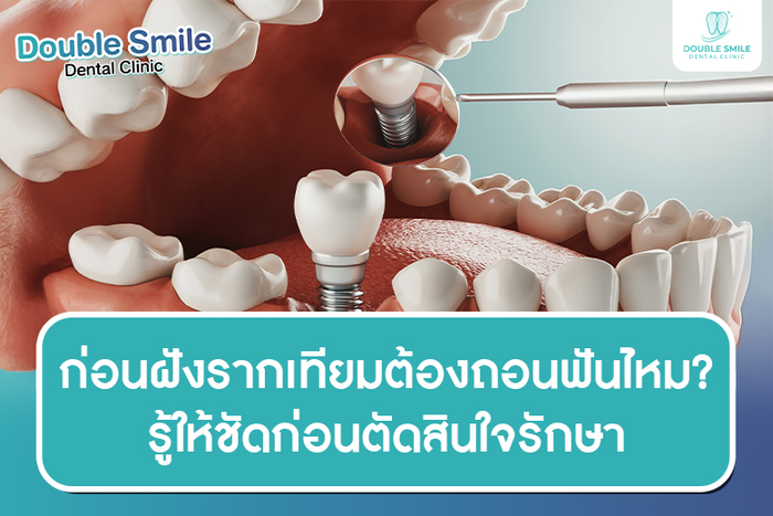 ก่อนฝังรากเทียมต้องถอนฟันไหม? รู้ให้ชัดก่อนตัดสินใจรักษา