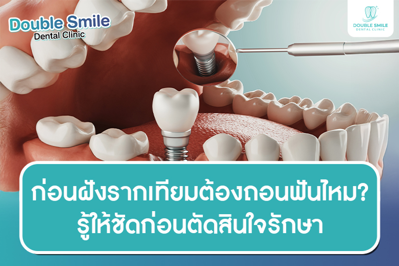 ก่อนฝังรากเทียมต้องถอนฟันไหม? รู้ให้ชัดก่อนตัดสินใจรักษา