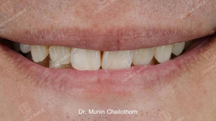 เคสรีวิวอุดฟันและวีเนียร์ 39