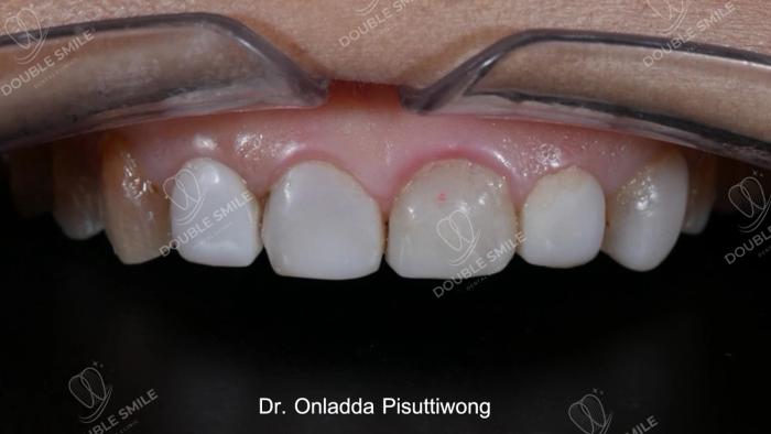 เคสรีวิวอุดฟันและวีเนียร์ 37