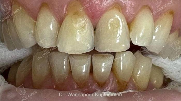 เคสรีวิวฟอกสีฟัน 16