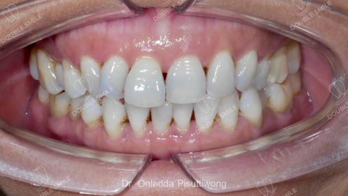 เคสรีวิวอุดฟันและวีเนียร์ 44