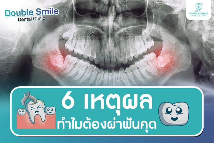 6 เหตุผล ทำไมต้องผ่าฟันคุด