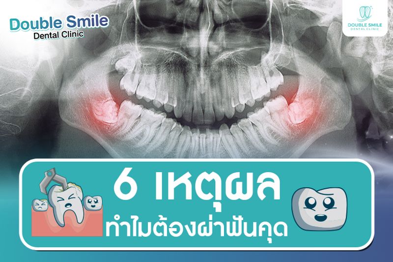 6 เหตุผล ทำไมต้องผ่าฟันคุด