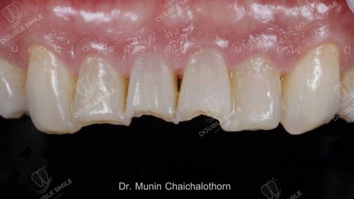 เคสรีวิวอุดฟันและวีเนียร์ 35