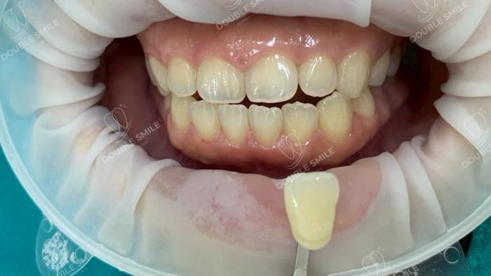 เคสรีวิวฟันปลอม 12