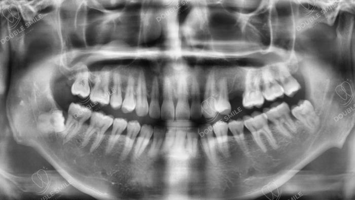 เคสรีวิวรากเทียม 18