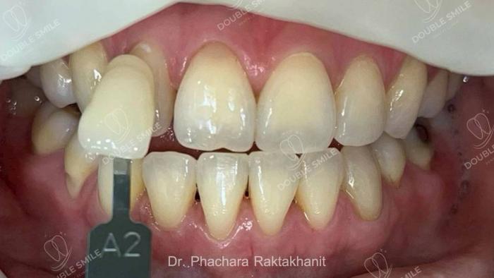 เคสรีวิวฟอกสีฟัน 12