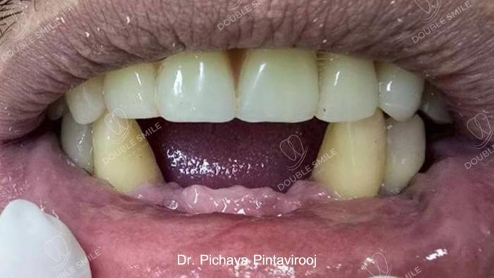 เคสรีวิวฟันปลอม 10