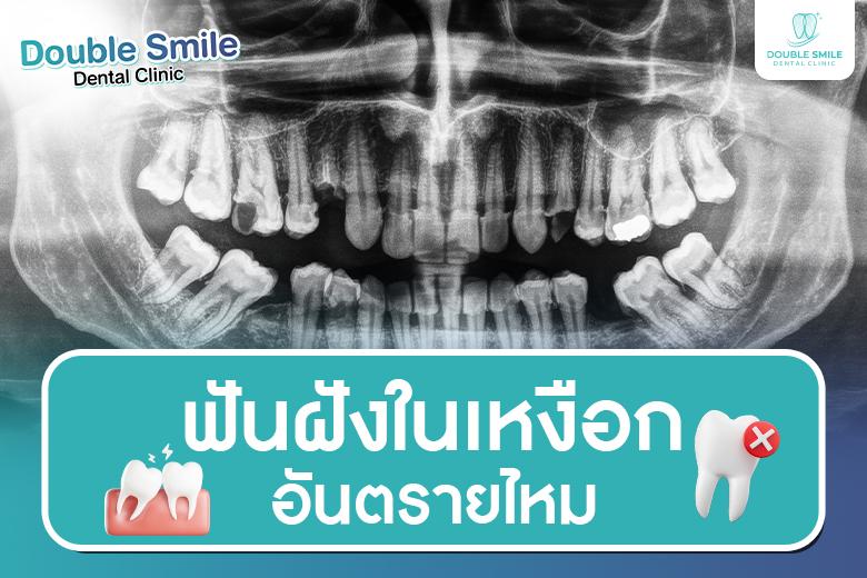 ฟันฝังในเหงือก อันตรายไหม? เรื่องใกล้ตัวที่ไม่ควรมองข้าม